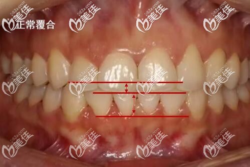 牙齒正常咬合圖