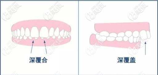 深覆合和深覆蓋區(qū)別圖片