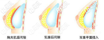 雙平面假體隆胸植入層次示意圖