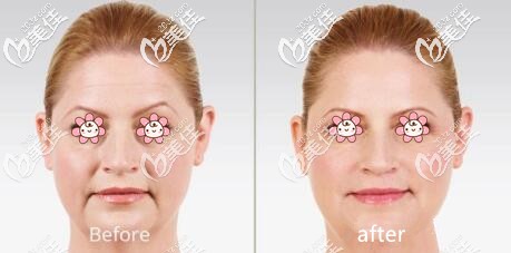 去除法令紋案例 去除法令紋案例