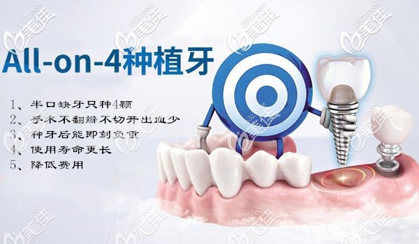 美奧口腔allon4半口全口種植牙技術(shù) 美奧口腔allon4半口全口種植牙技術(shù)