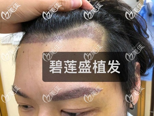用我微針植發(fā)際線+種植眉毛五天的親身經(jīng)歷告訴你：男士植眉不全都是后悔的