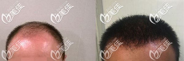 大面積植發(fā)5300毛囊單位術后8個月對比效果圖 大面積植發(fā)5300毛囊單位術后8個月對比效果圖