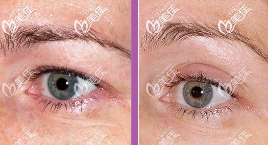 熱瑪吉治療眼部皺紋的圖片