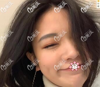 我術(shù)前的鼻子 我術(shù)前的鼻子