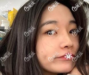 我在泰國(guó)然禧隆鼻一個(gè)月了 我在泰國(guó)然禧隆鼻一個(gè)月了