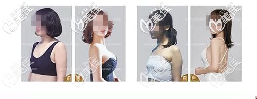 極速豐胸真人案例