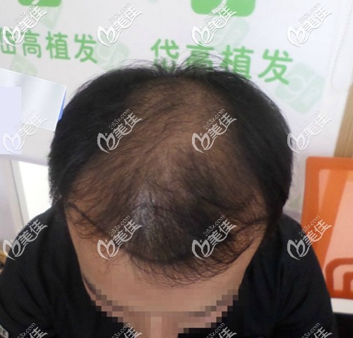 來(lái)醫(yī)院做頭發(fā)檢查面診 來(lái)醫(yī)院做頭發(fā)檢查面診