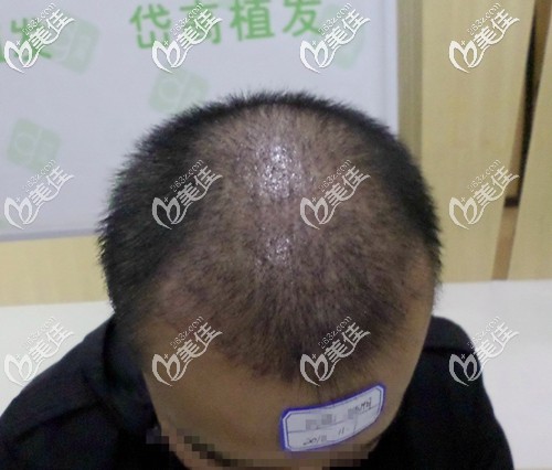 微針頭頂加密種植 微針頭頂加密種植