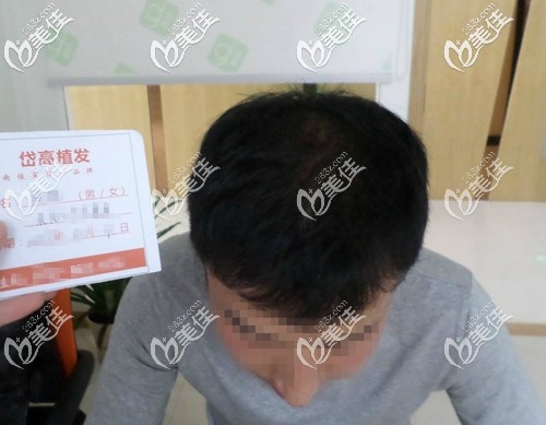 植發(fā)術(shù)后一年頭發(fā)還是稀疏,又到長(zhǎng)沙找了一家植發(fā)醫(yī)院看診后才知道原來(lái)我植發(fā)失敗了!
