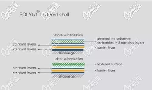 德國寶儷假體隆胸優(yōu)勢