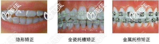 牙套的種類 牙套的種類