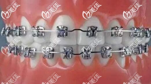 金屬鋼牙套 金屬鋼牙套