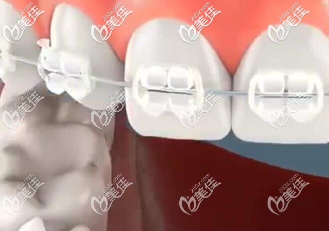 陶瓷半隱形牙套 陶瓷半隱形牙套