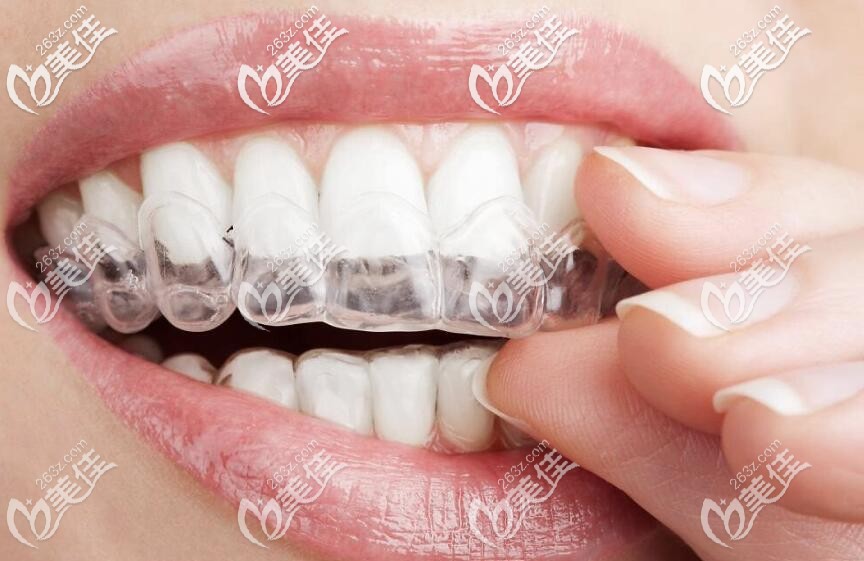 無托槽隱形牙套 無托槽隱形牙套