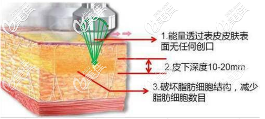 超聲吸脂的過程 超聲吸脂的過程