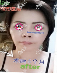 在泰國做完面部拉皮手術(shù)后皮膚緊致還不僵硬，也沒有之前那么難看了