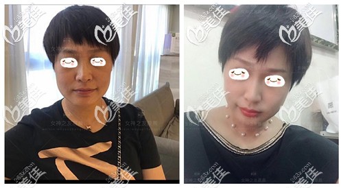 面部埋線提升后效果前后對比