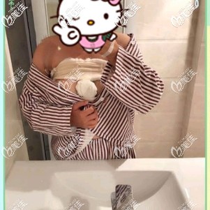 做完藍(lán)貝假體隆胸術(shù)后即刻 做完藍(lán)貝假體隆胸術(shù)后即刻