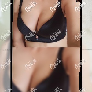 隆胸假體不止有曼托、妙桃，國(guó)產(chǎn)藍(lán)貝假體豐胸術(shù)后68天恢復(fù)效果也不賴(lài)