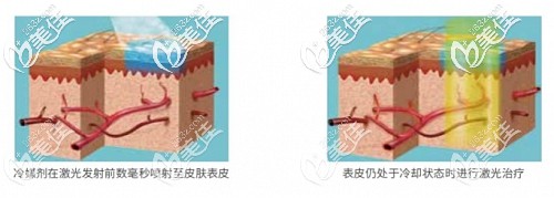 染料激光去紅血絲的原理