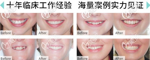龔博林醫(yī)生的牙齒矯正案例 龔博林醫(yī)生的牙齒矯正案例