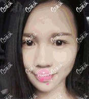 術(shù)前下巴短縮顯得土氣 術(shù)前下巴短縮顯得土氣