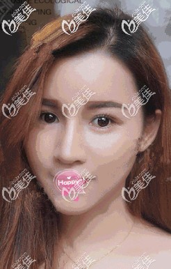 聽網友說墊下巴千萬不要用假體很費解 我想說親自體驗萬和硅膠豐下巴效果不僅自然還不貴