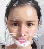 假體墊下巴術(shù)后拆線 假體墊下巴術(shù)后拆線