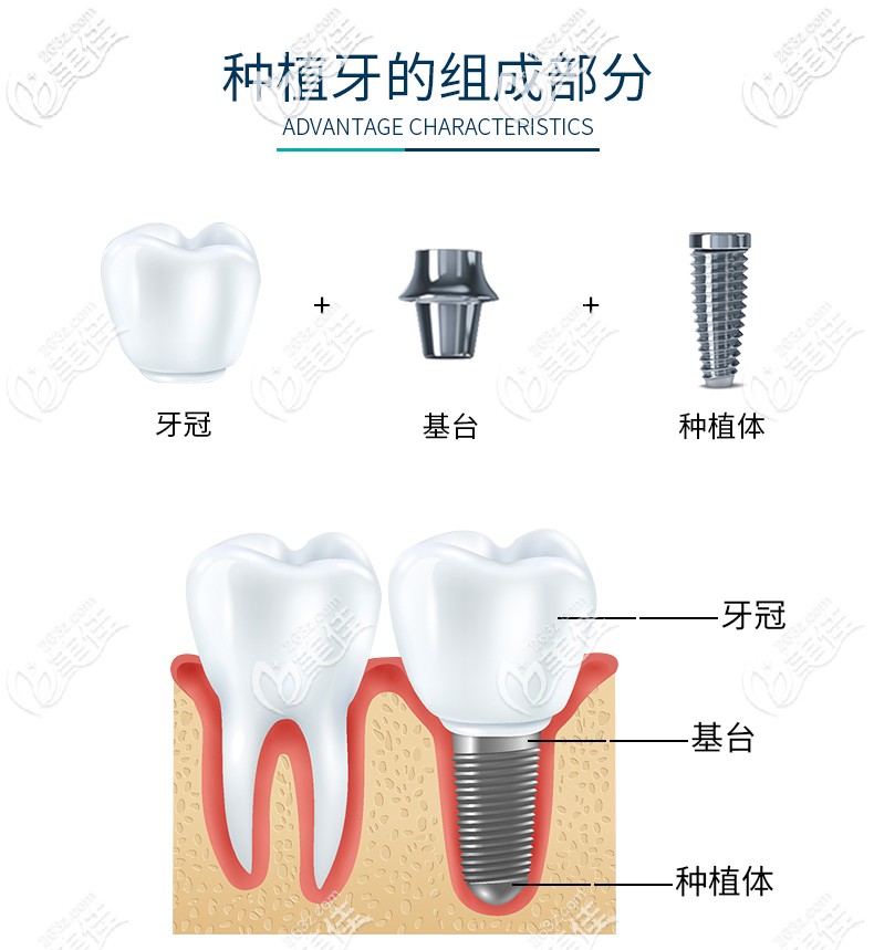 iti種植體結(jié)構(gòu)組成部分