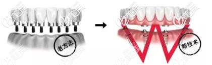 半口種植牙和傳統(tǒng)種植牙區(qū)別