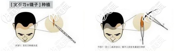 fue無痕植發(fā)技術(shù)手術(shù)過程 fue無痕植發(fā)技術(shù)手術(shù)過程