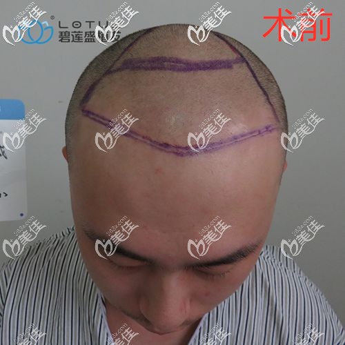 做頭頂加密術(shù)前圖片 做頭頂加密術(shù)前圖片