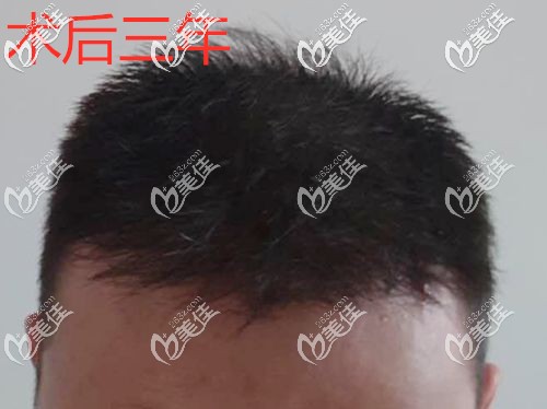 用我的真實加密植發(fā)經(jīng)歷告訴你：植的頭發(fā)兩年就掉了的情況并不是人人都有