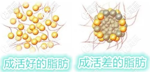 成活率高的脂肪和成活率低的脂肪對比 成活率高的脂肪和成活率低的脂肪對比