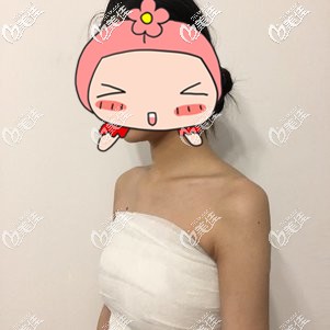 復(fù)合隆胸術(shù)后即刻胸部飽滿 復(fù)合隆胸術(shù)后即刻胸部飽滿