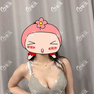 隆胸術(shù)后26天腫脹漸消 隆胸術(shù)后26天腫脹漸消