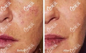 激光去紅血絲效果前后對(duì)比