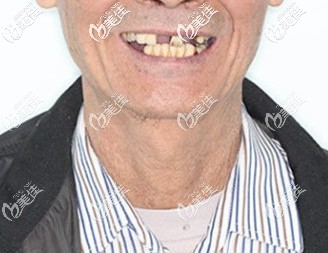 王叔種牙前口腔狀況 王叔種牙前口腔狀況