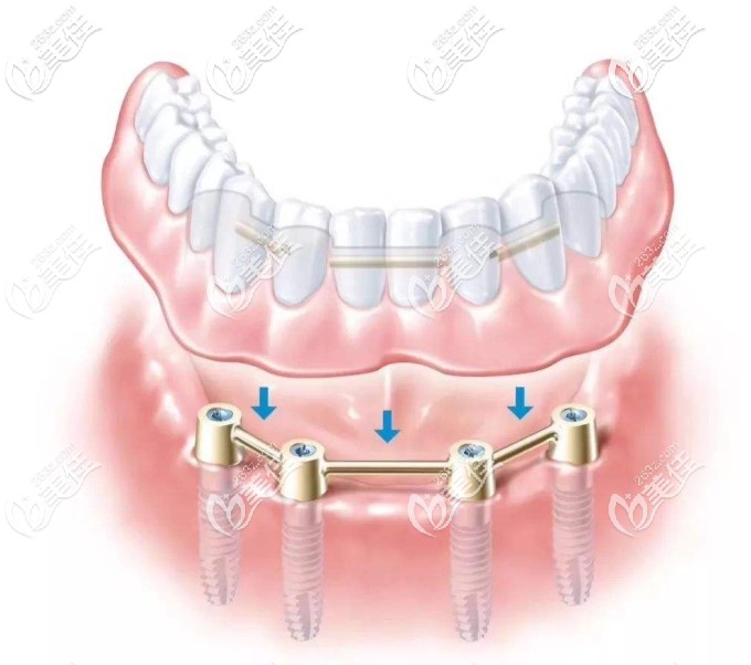 下半口allon4種植示意圖 下半口allon4種植示意圖