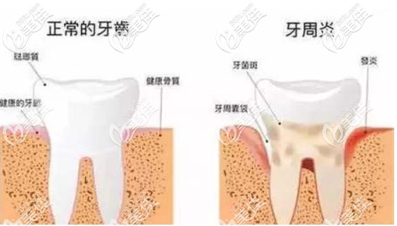 章立群博士教大家學(xué)習(xí)如何判斷自己是否有牙周炎 章立群博士教大家學(xué)習(xí)如何判斷自己是否有牙周炎