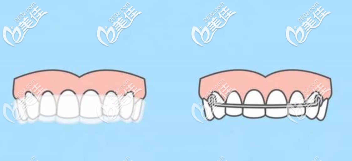 做隱形矯正會不會反彈主要和有沒有好好佩戴保持器有關(guān)