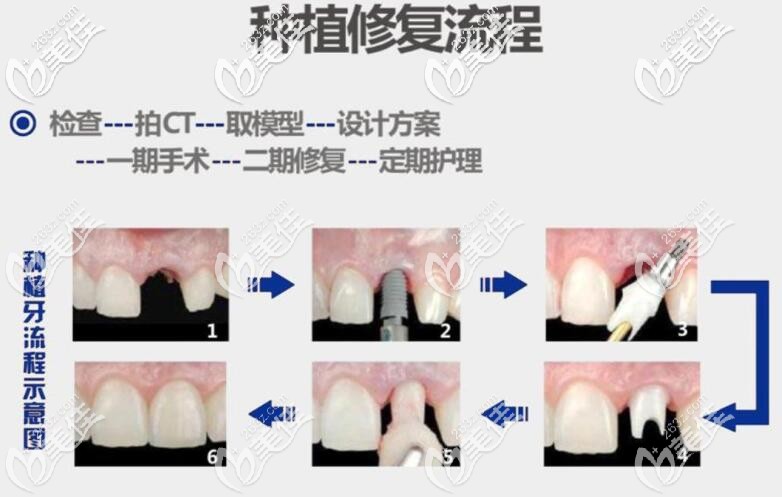 種植牙修復(fù)過程 種植牙修復(fù)過程