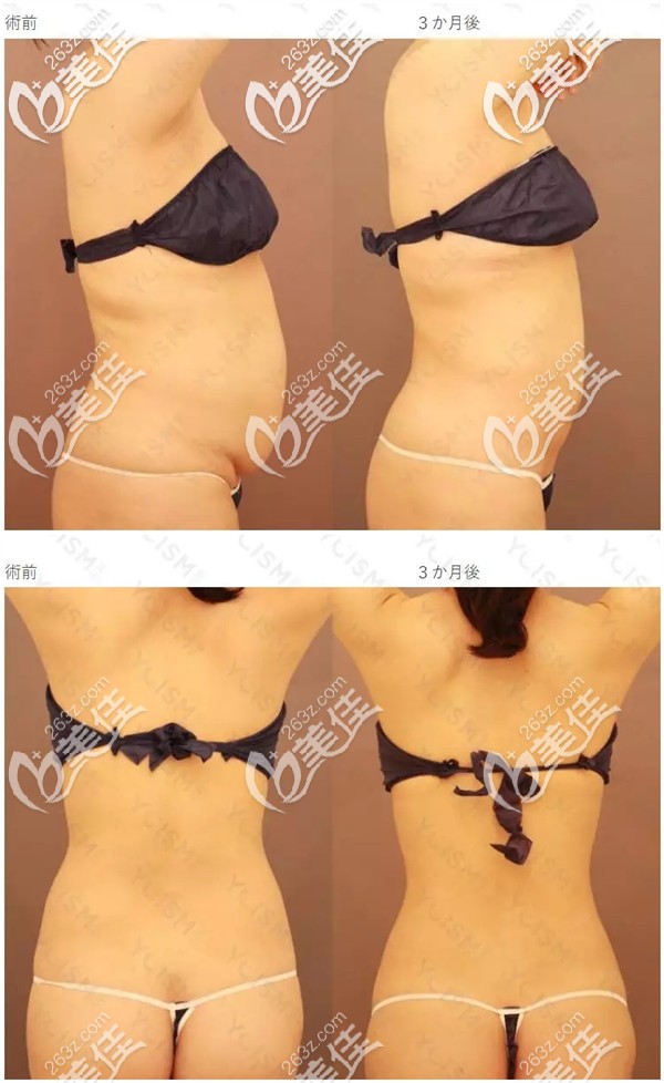 腰腹部吸脂對比案例