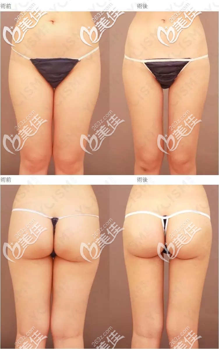 大腿臀部吸脂對比案例
