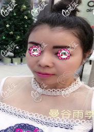 在泰國做下巴前樣子 在泰國做下巴前樣子