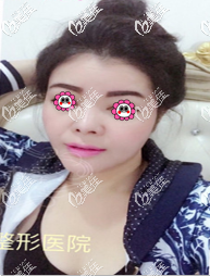 當(dāng)時(shí)在泰國做假體下巴恢復(fù)期也沒有想象那般痛苦,如今效果也蠻自然的