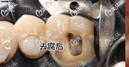 海南微笑口腔補牙真人案例