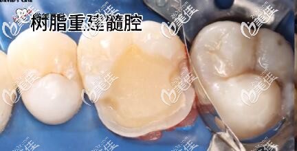 三亞微笑牙科補牙案例