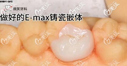 海南微笑牙科e-max瓷嵌體補牙案例